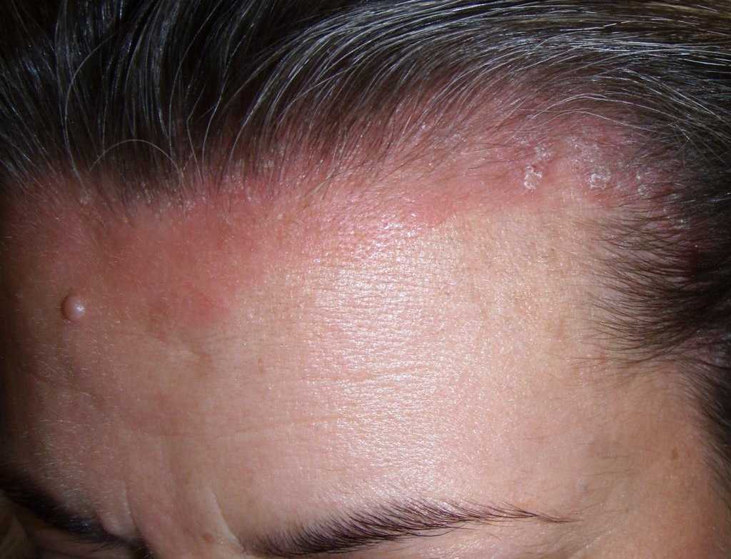 Mild scalp psoriasis pictures