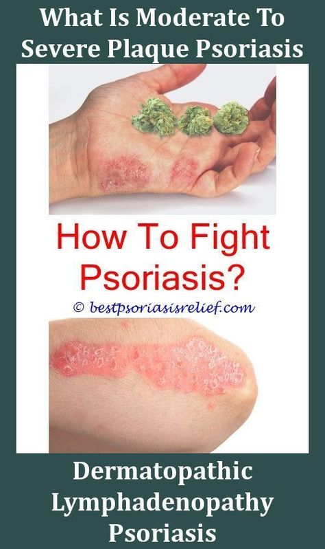 Mildpsoriasis Are Eczema And Psoriasis The Same How To Get ...