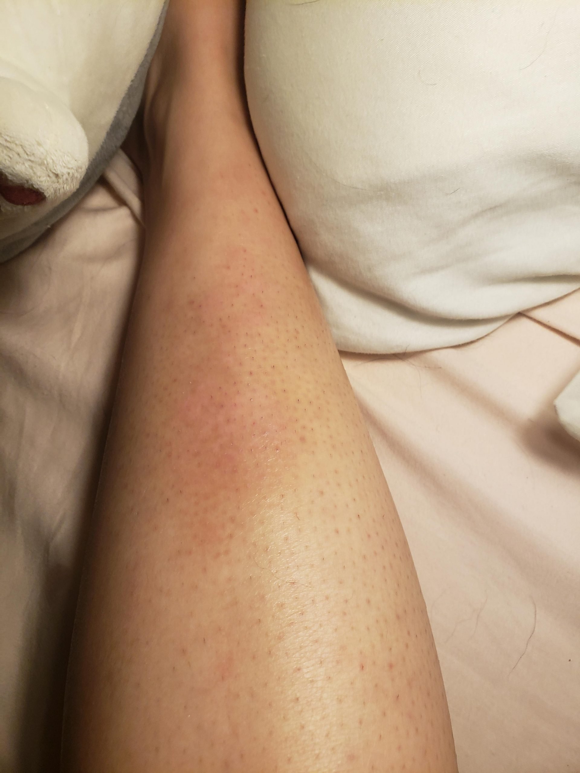 My right leg (and my biggest psoriasis patch) this morning. This week ...