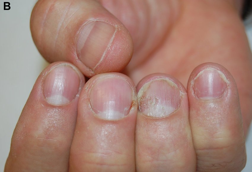 Nail psoriasis (A) before and (B) after treatment with ...
