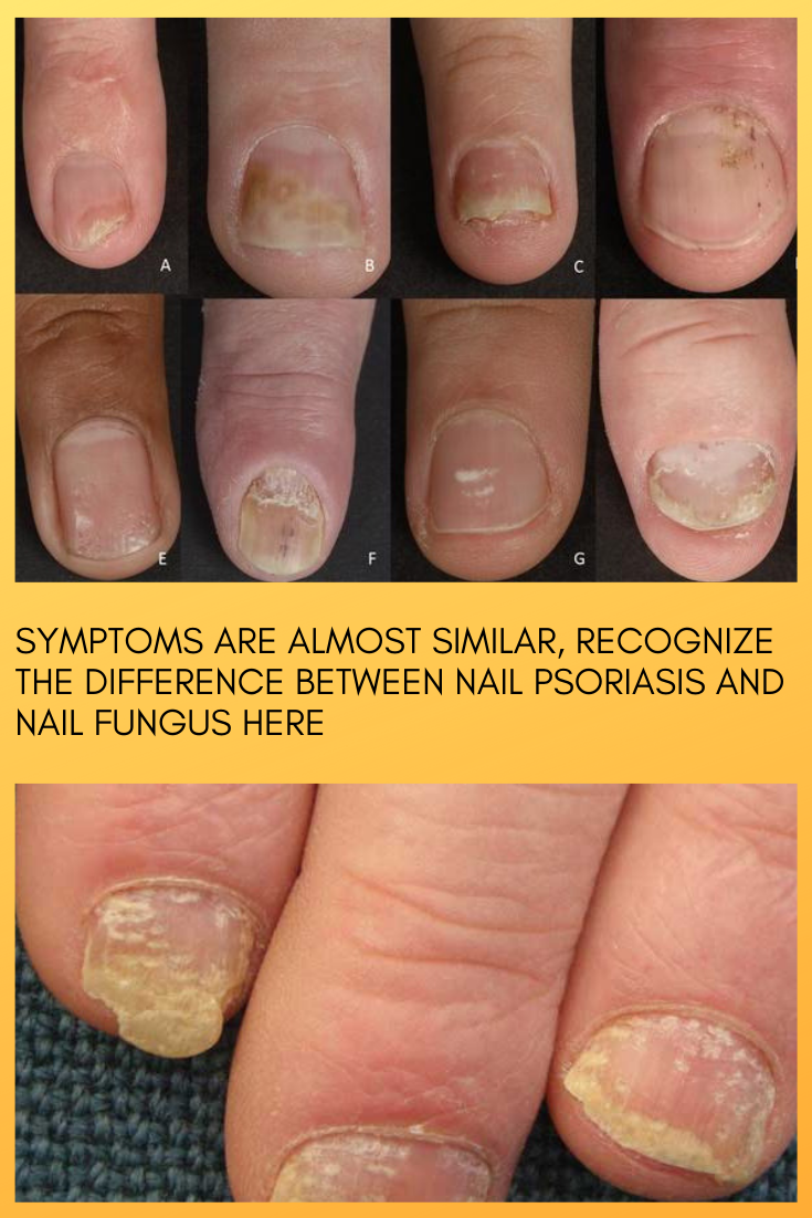 Nail psoriasis and nail fungus can look the same, but both ...