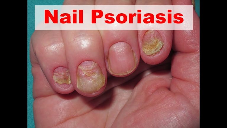 Nail psoriasis symptoms