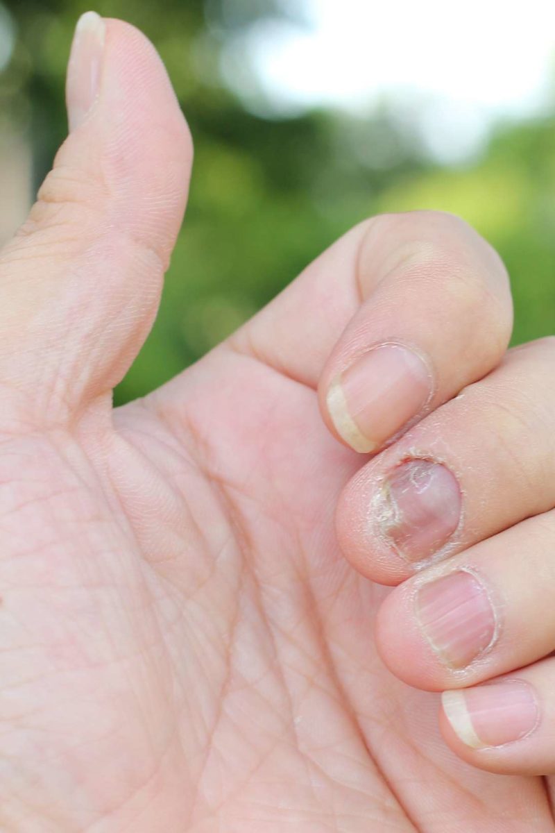 Nail psoriasis: What is it, treatment, and home remedies