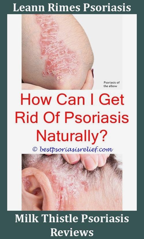 Nailpsoriasis Psoriasis What Does It Look Like Can ...
