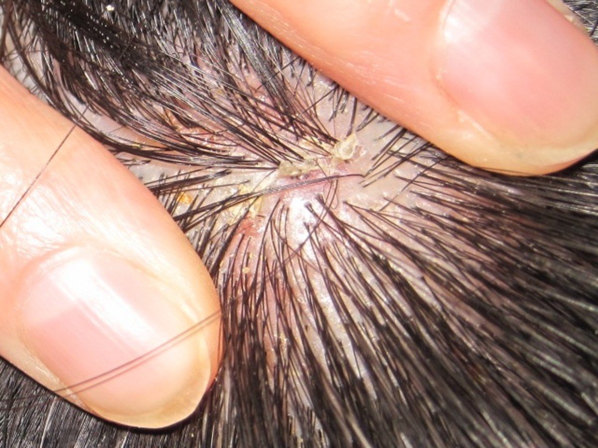 Natural and Alternative Treatments for Scalp Psoriasis ...