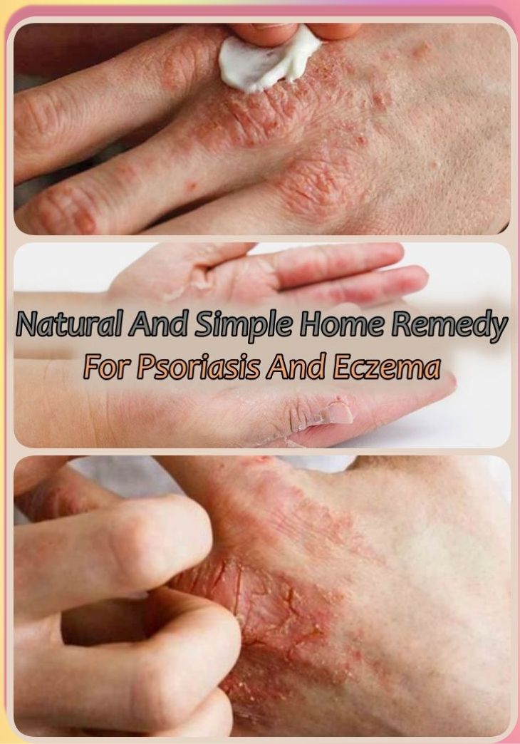 Natural And Simple Home Remedy For Psoriasis And Eczema