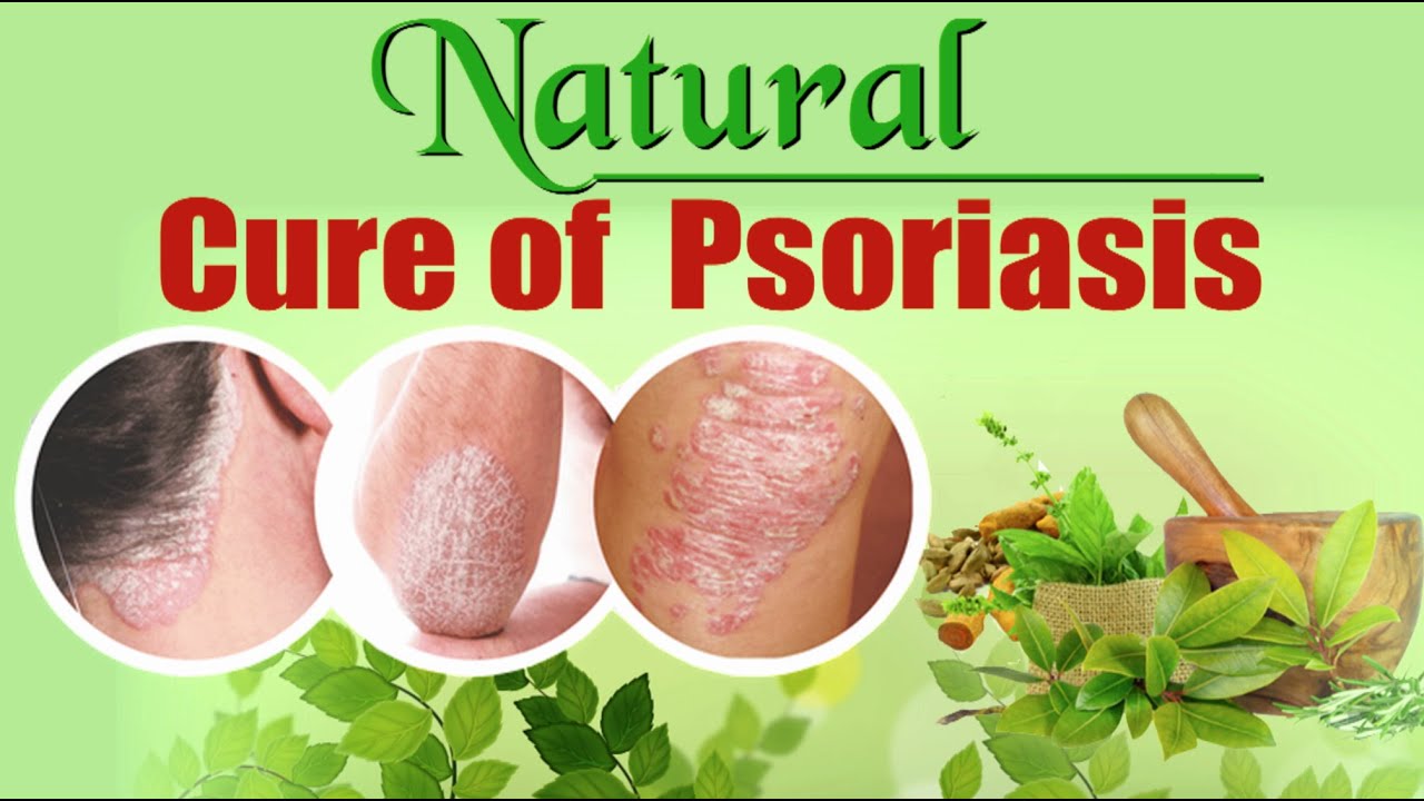 Natural Cure For Psoriasis