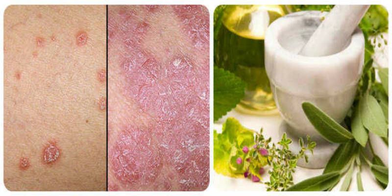 Natural Cure for the Psoriasis and Other Skin Diseases ...
