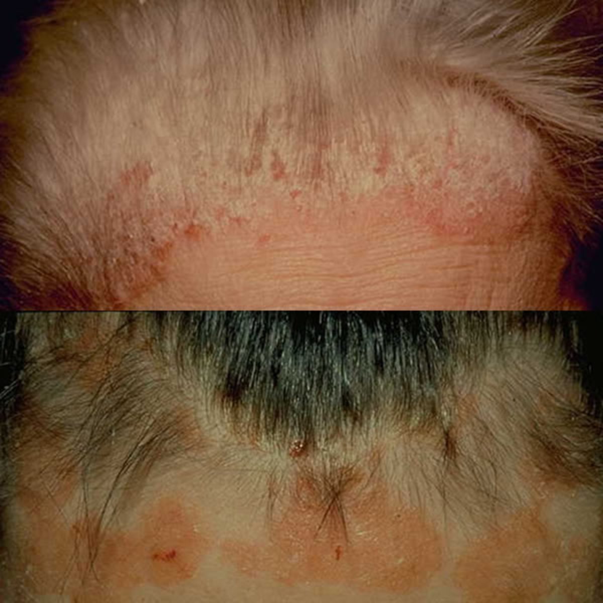 Natural Scalp Psoriasis Treatment With Tea Tree Oil and Olive Oil ...