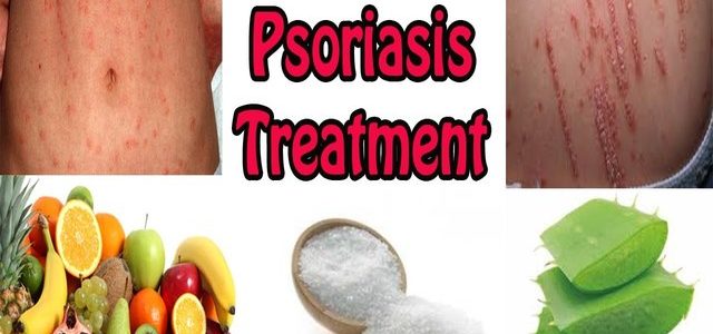 Natural Ways To Treat Guttate Psoriasis