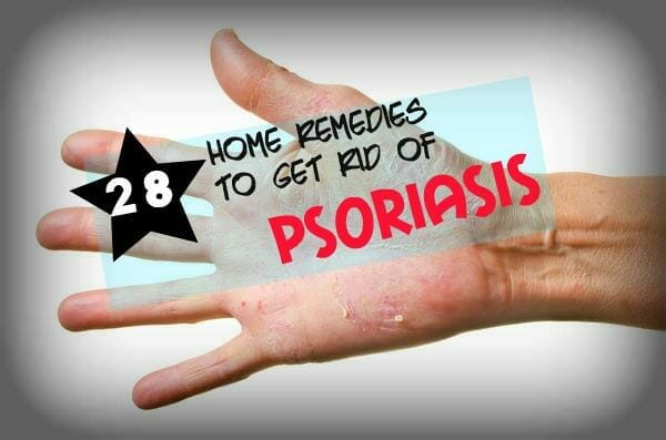 Natural Ways to Treat Psoriasis at Home