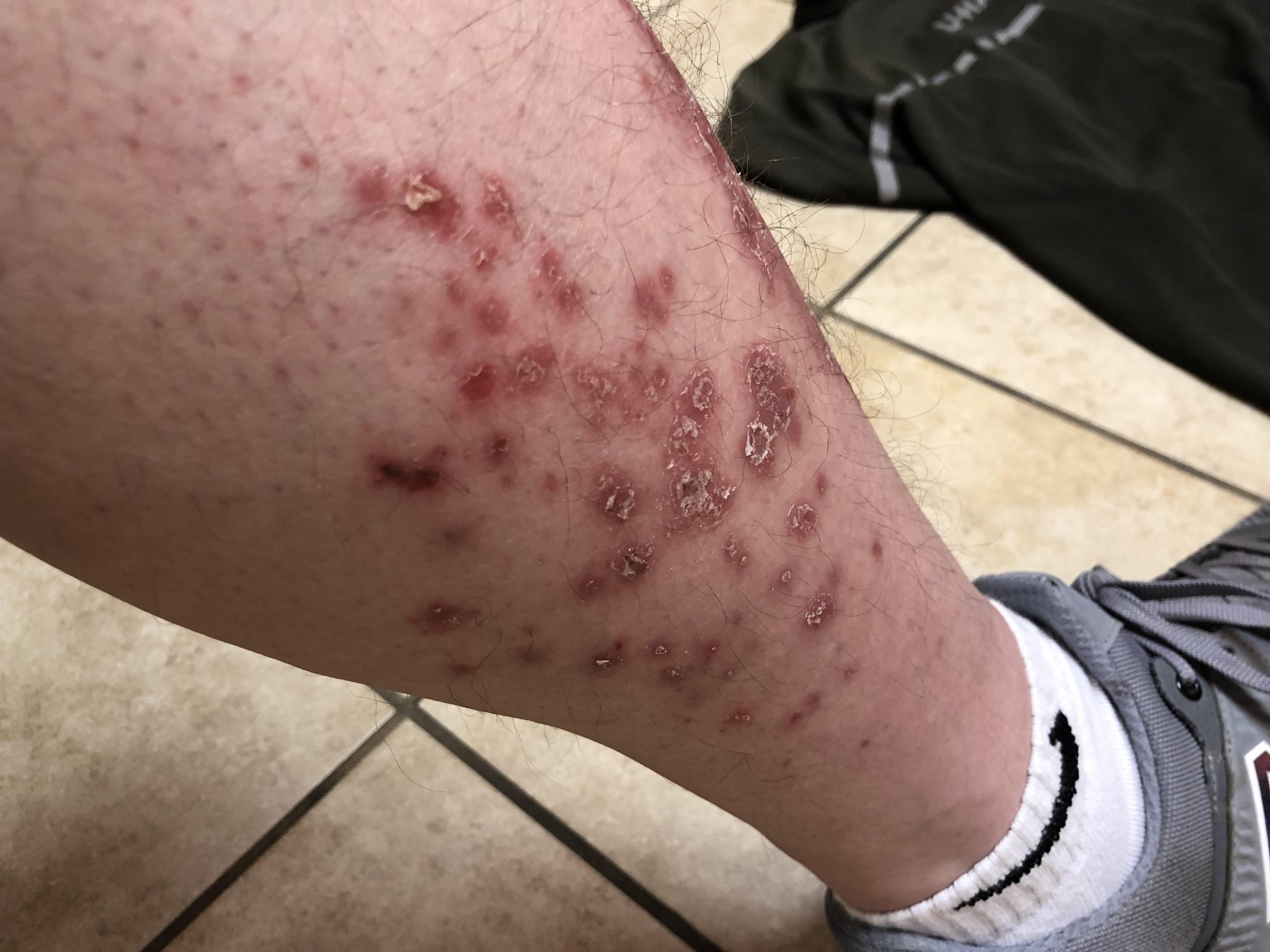New flair up with numbness? : Psoriasis