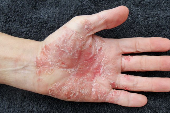 New psoriasis drug shows