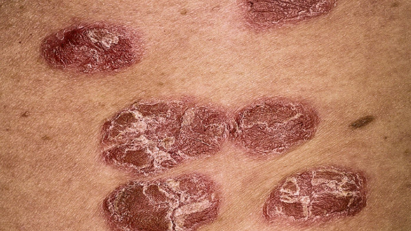New treatment for psoriasis sufferers