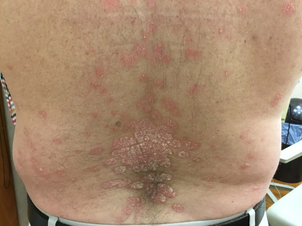 Novel therapy takes clearance of psoriasis to new heights