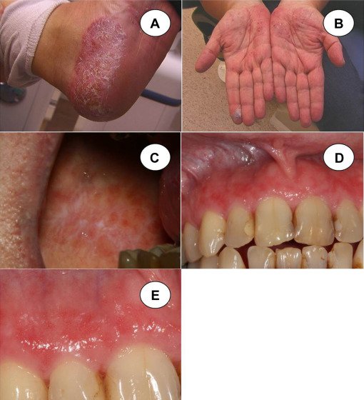 Oral psoriasisa diagnostic dilemma: a report of two cases ...