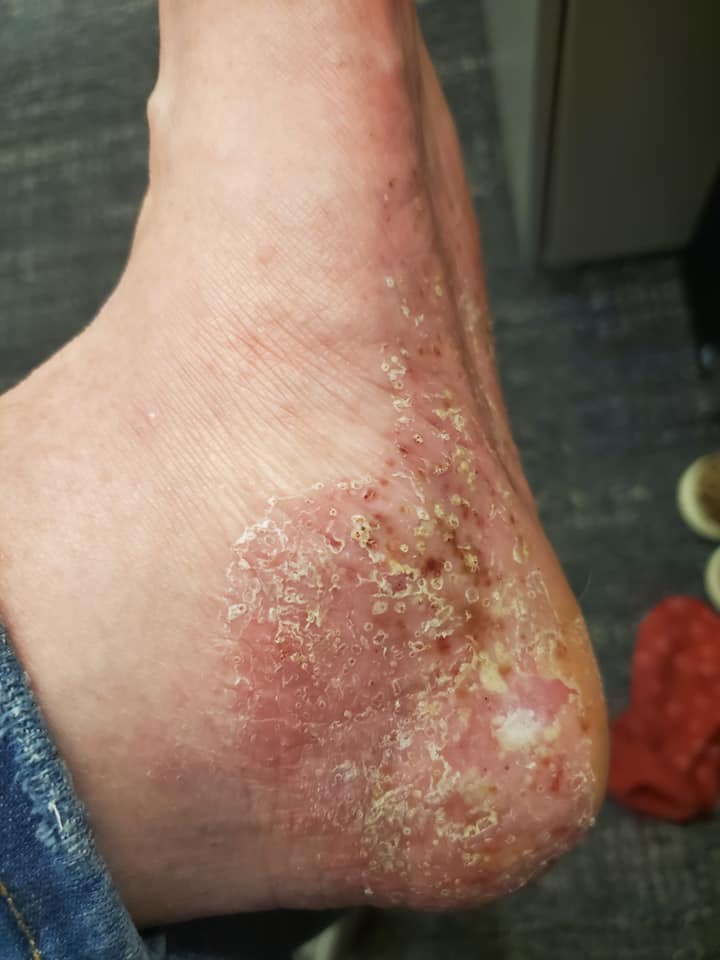 Otezla for Psoriasis Reviews PICTURES (After 6 Weeks)