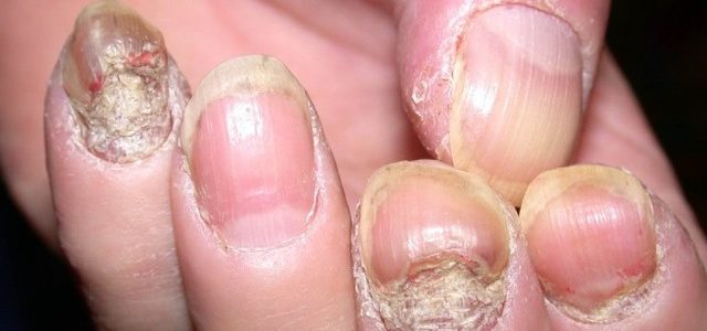 Over The Counter Nail Psoriasis Treatment