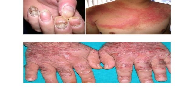 Over The Counter Treatment For Psoriasis On Hands