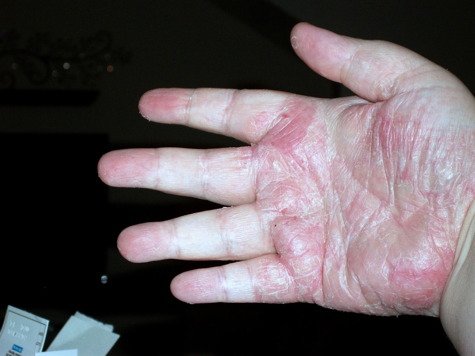 Palmo Plantar Pustular Psoriasis Sucks!!: My hands and ...