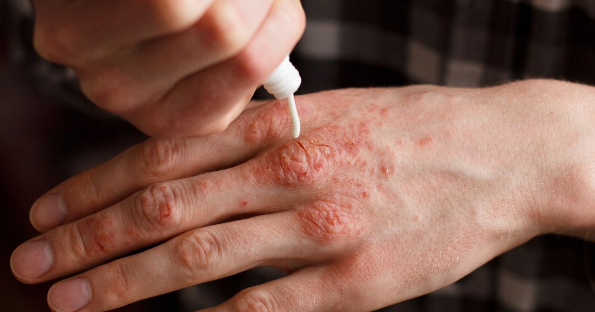 Palmoplantar Psoriasis: What Is It and How Do You Treat It?