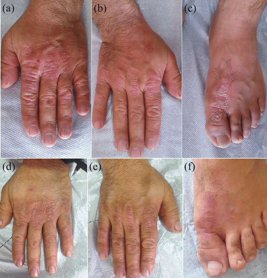 Patient with psoriasis displaying moderate improvement of ...