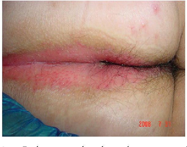 [PDF] Inverse Psoriasis Involving Genital Skin Folds: Successful ...