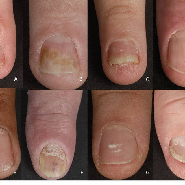 (PDF) Nail Psoriasis: A Review of Treatment Options