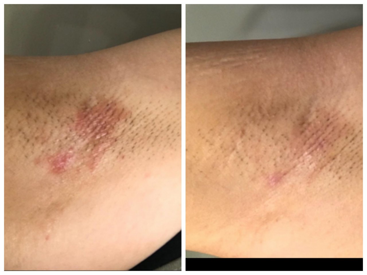 Phototherapy Psoriasis Before and After PICTURES (Side Effects)