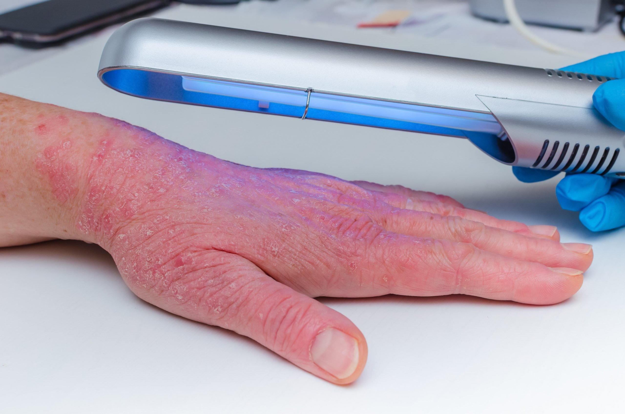 Phototherapy safe, effective for psoriasis