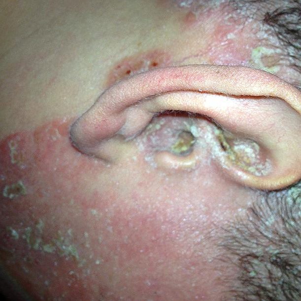 Picture of Psoriasis of the Ear * Otolaryngology Houston
