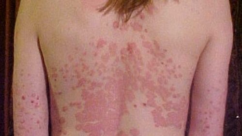 Pictures of Psoriasis and its Treatments!