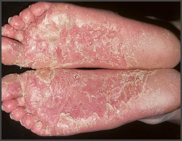 pictures of psoriasis on bottom of feet