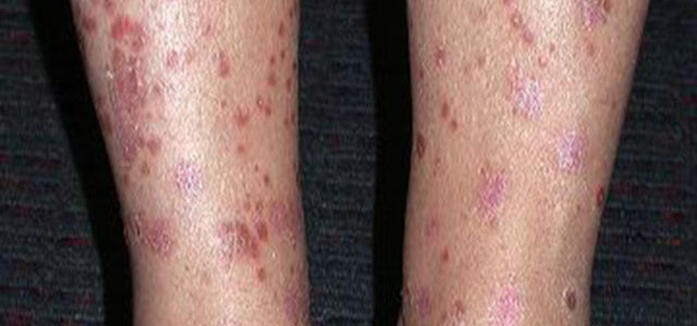 Pictures Of Psoriasis On Legs And Arms