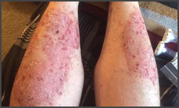 Pictures of psoriasis on legs