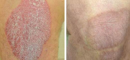 Pictures of psoriasis on legs, pustular psoriasis on feet ...