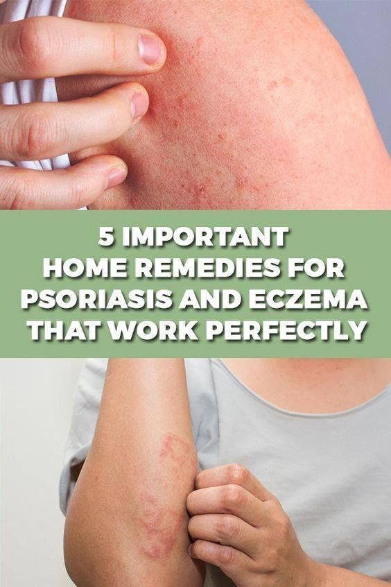 Pin by Sarah lynn on psoriasis in 2020