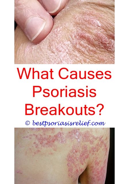 Pin on How To Treat Psoriasis