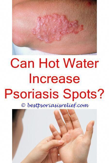 Pin on Psoriasis cure