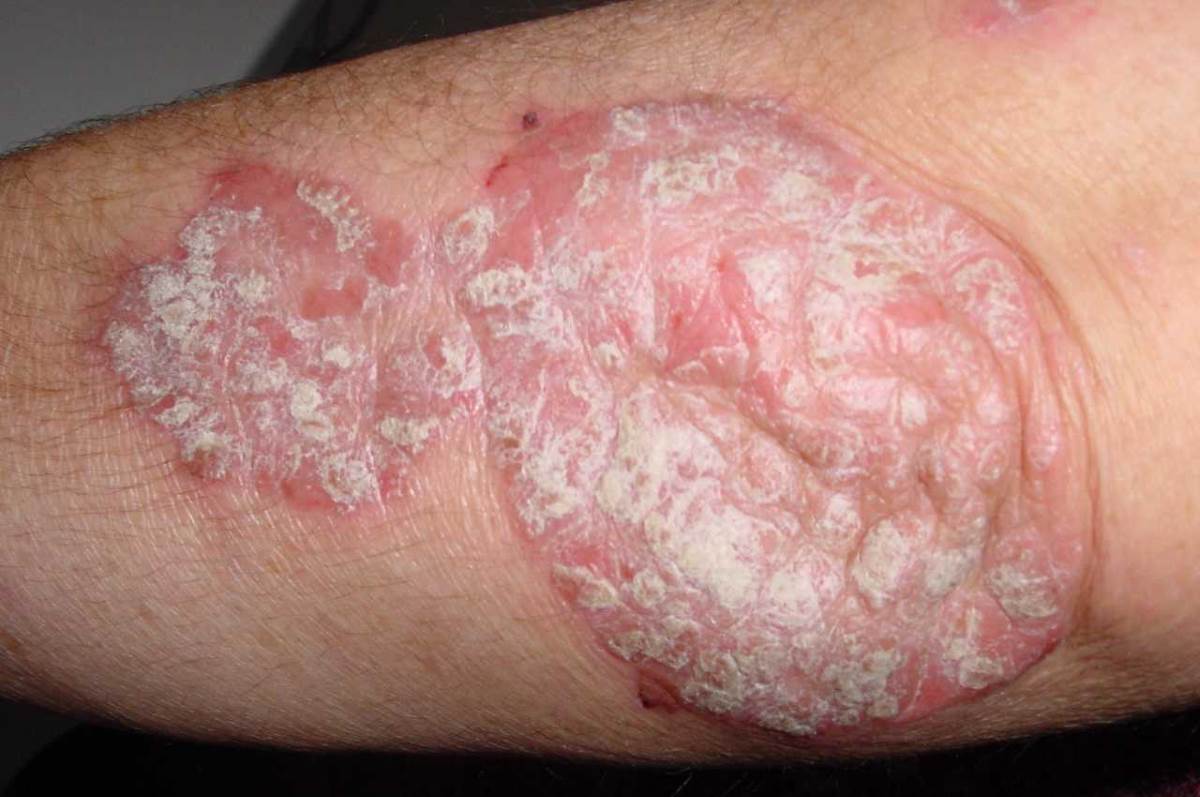 Plaque psoriasis on elbow pictures