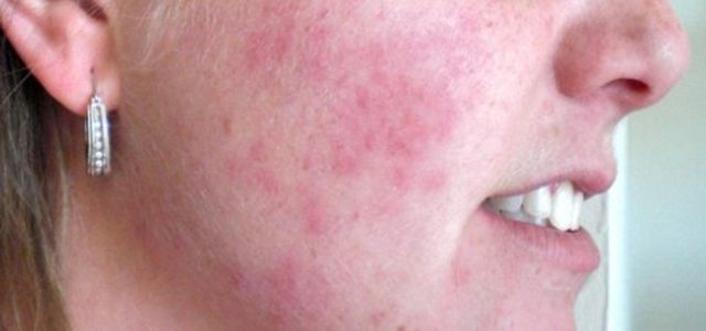 Plaque Psoriasis On Face