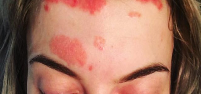 Plaque Psoriasis On Face Pictures