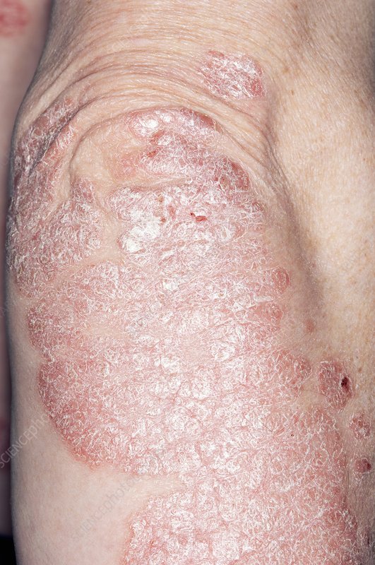 Plaque psoriasis on the elbow
