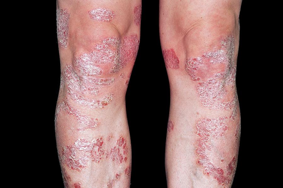 Plaque Psoriasis On The Legs Photograph by Dr P. Marazzi ...