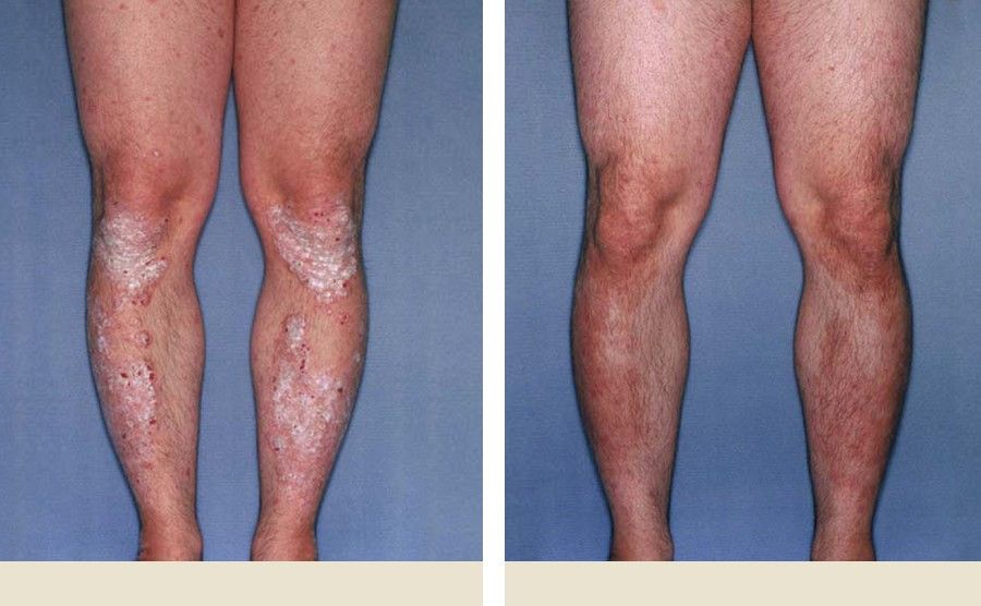 Plaque Psoriasis Pictures Before &  After HUMIRA® Use ...