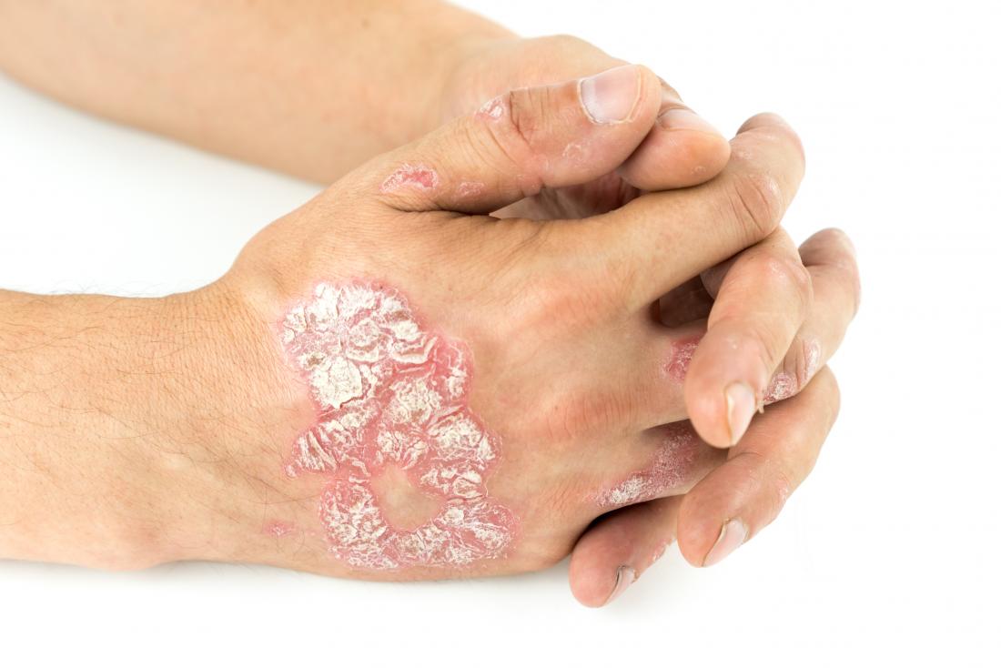 Plaque psoriasis: Pictures, symptoms, and severity