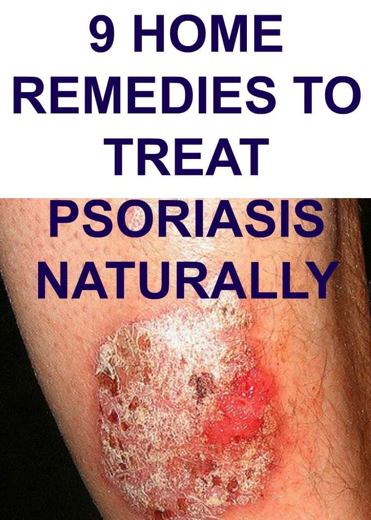 Plaque Psoriasis Scalp Home Remedy