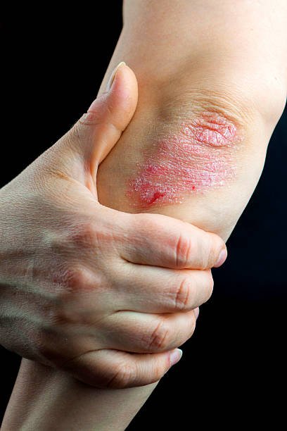 Plaque Psoriasis Stock Photos, Pictures &  Royalty