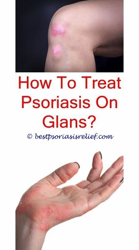 plaquepsoriasiscauses what causes psoriasis to flare up ...
