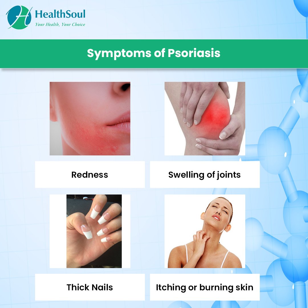 Psoriasis â Causes, Symptoms, Diagnosis, Treatment ...